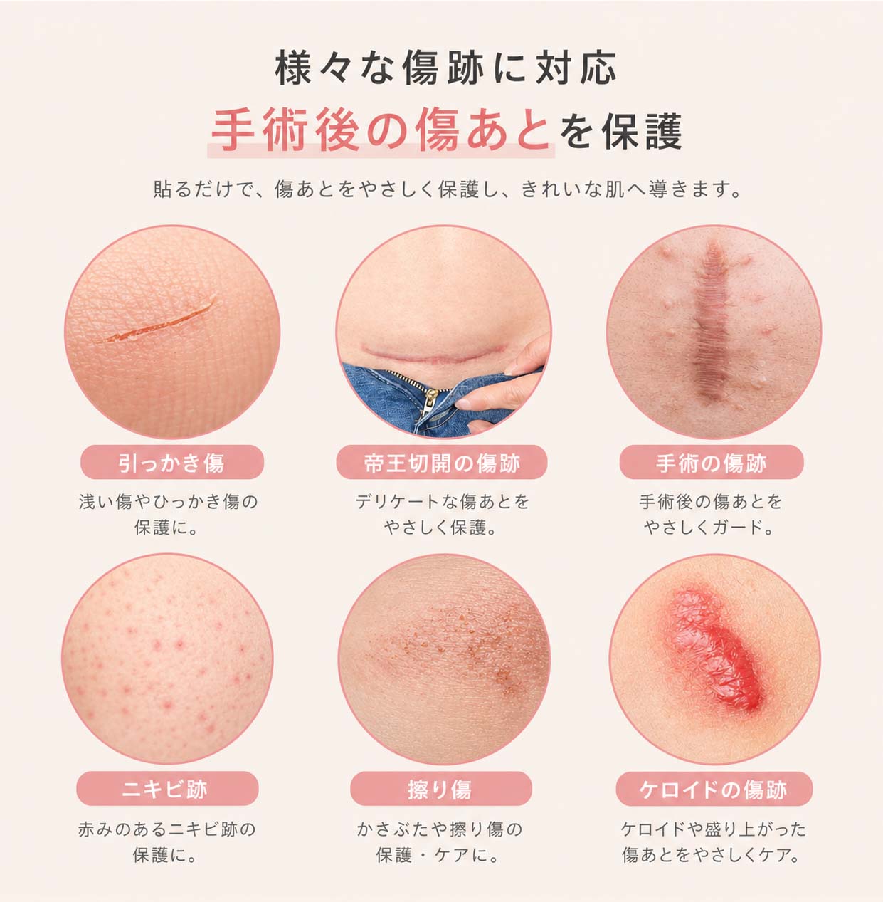 Nopra（ノプラ） 傷あとケアテープ 1.5m 3m 帝王切開 傷跡テープ 手術後 手術 傷テープ キズアト 傷跡ケロイド シリコンテープ 紫外線カット 手術跡ケア 傷あとを目立たなくする 傷跡 隠し 傷あとテープ シリコン テープ メイク マミエル - Nopra（ノプラ）公式 / 月経カップ・月経ディスク