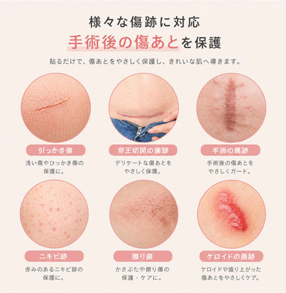 Nopra（ノプラ） 傷あとケアテープ 1.5m 3m 帝王切開 傷跡テープ 手術後 手術 傷テープ キズアト 傷跡ケロイド シリコンテープ 紫外線カット 手術跡ケア 傷あとを目立たなくする 傷跡 隠し 傷あとテープ シリコン テープ メイク マミエル - Nopra（ノプラ）公式 / 月経カップ・月経ディスク